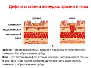 Эффективна ли замена кардимагнила на клопидогрель при эрозии желудка