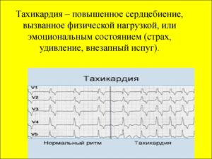 Усиливается сердцебиение при движениях