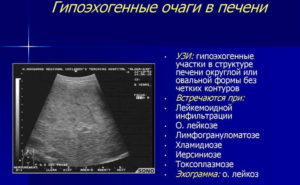 Округлое образование в s4 сегменте печени