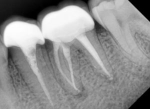 Перелечивание каналов зуба