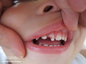 Откололся кусочек зуба у ребенка