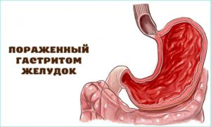 Панкреатит, гастрит или стресс