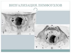 Лимфоузлы визуализируются