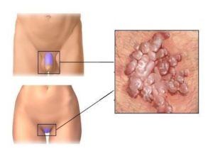 Зуд малых половых губ и входа во влагалище