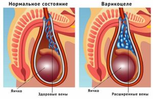 Возникновение варикоцеле от мастурбации