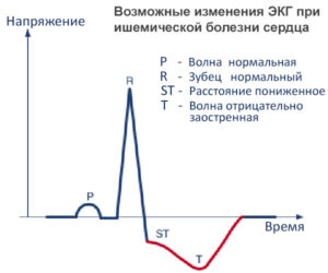 ЭКГ может ли не обнаружить заболевания сердца?