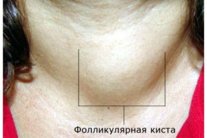 Плотная щитовидная железа