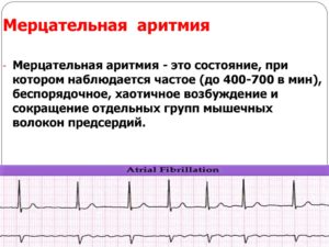 Аритмия или всд