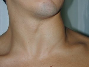 Увеличены лимфоузлы на шее, жжение в шее и груди