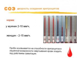 Высокое Соэ после лечения антибиотиками