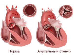 Склеротические изменения стенок МК, АОК.