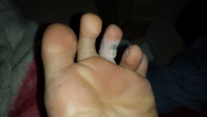 Уплотнение кожи на пальцах ног