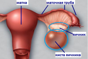 Киста яичника у девственниц