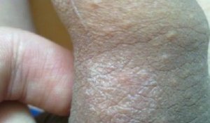 Сухая кожа головки полового члена после тридерма, проблемы с потенцией
