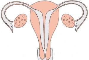 Планирование беременности с маточной перегородкой
