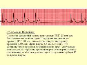 АВ блокады 2 ст. Тип 1 у ребенка, занимается спортом