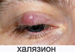Сколько можно подождать, пока халязион сам рассосется?