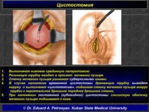 Как начать самостоятельно мочиться после цистотомы