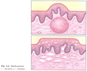 Гиперкератоз слизистой щеки