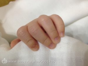 У новорожденного пятно под ногтем пальцев