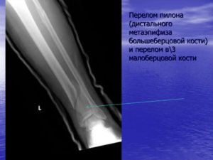 Перелом дистального отдела большеберцовой кости закрытый перелом (снимки)