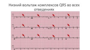 Экг. Снижен вольтаж