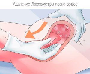 Кровотечение после секса после родов