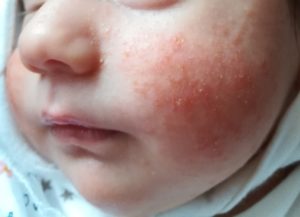 Высыпания на лице у ребёнка 1 месяц