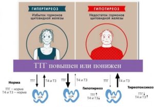 Признаки гипотиреоза при нормальных гормонах