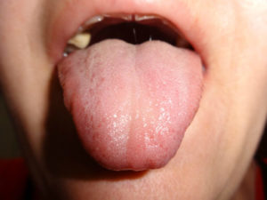Болит язык слева сбоку