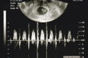 Сердцебиение у эмбриона