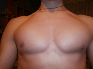 Асимметрия грудных мышц у мальчика