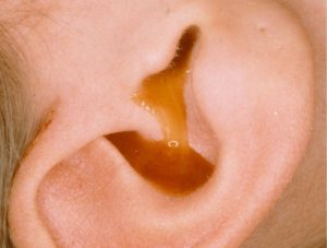 Внутри уха дырка