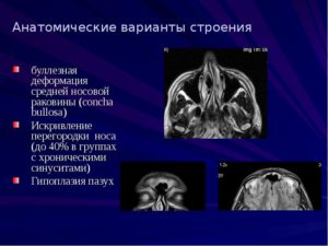 Чувство комка в горле Буллезная деформация носовой раковины
