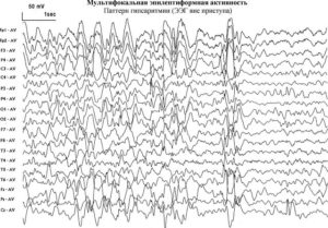 Эпи активность на ЭЭГ ребёнка 3 лет без приступов