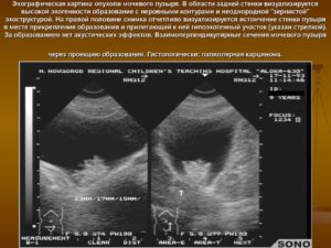 Объемное образование мочевого пузыря