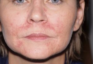 Ухудшение состояния кожи при лечении периорального дерматита