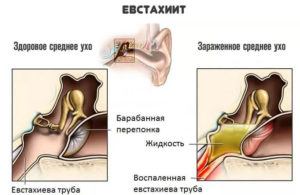 Закладывает уши и тяжело дышать