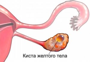 Лечение кисты желтого тела марвелоном