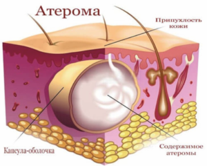 Уплотнение в месте удаления атеромы