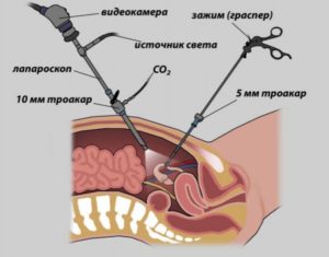 Эндометриоидная киста после лапароскопии