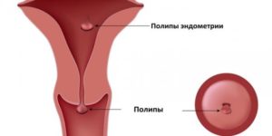 Возможность беременности при отсутствии матки