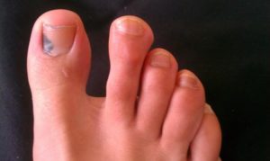 Темные пятна на ногтях обоих больших пальцев ног