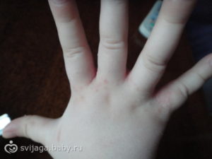Мелкие прыщики у ребенка на руке между пальцев