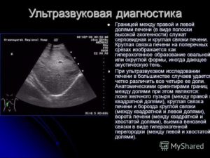 Округлое образование в s4 сегменте печени