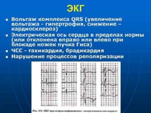 Экг. Снижен вольтаж