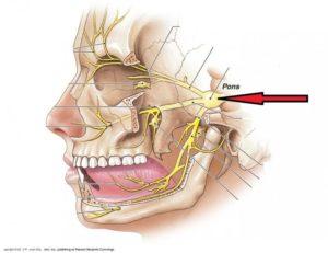 Удаление зуба при воспалении тройничного нерва