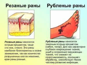 Осложнения рубленой раны кисти