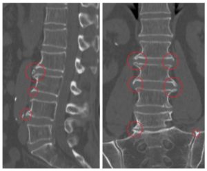 Темные пятна на рентгене пояснично крестцового отдела
