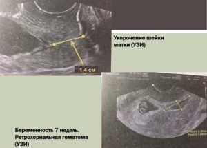 Клексан и ретрохориальная гематома